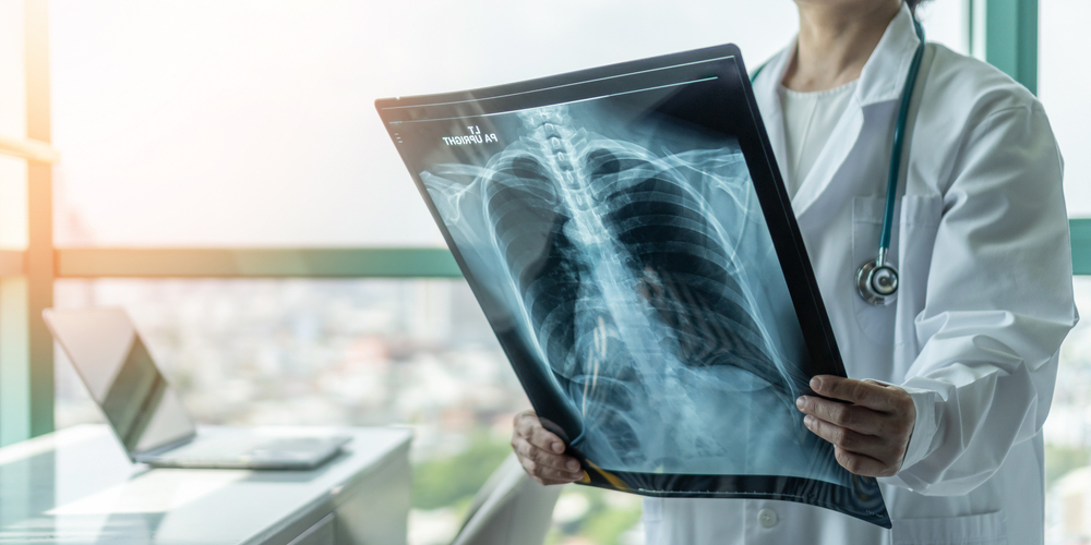 AKCİĞER EMBOLİSİ (Pulmoner Emboli)